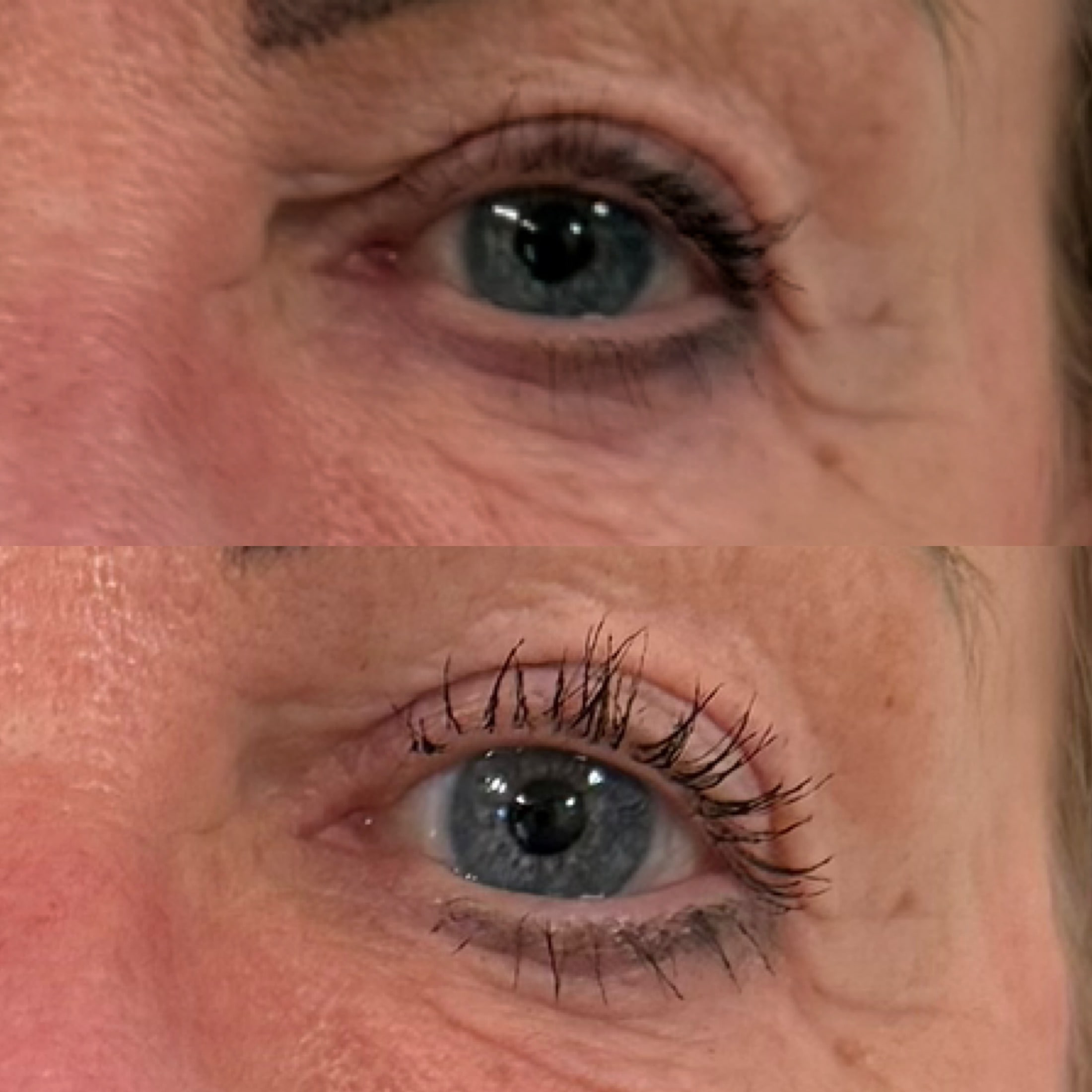 Brynløft med botox i kosmetisk klinik i Odense