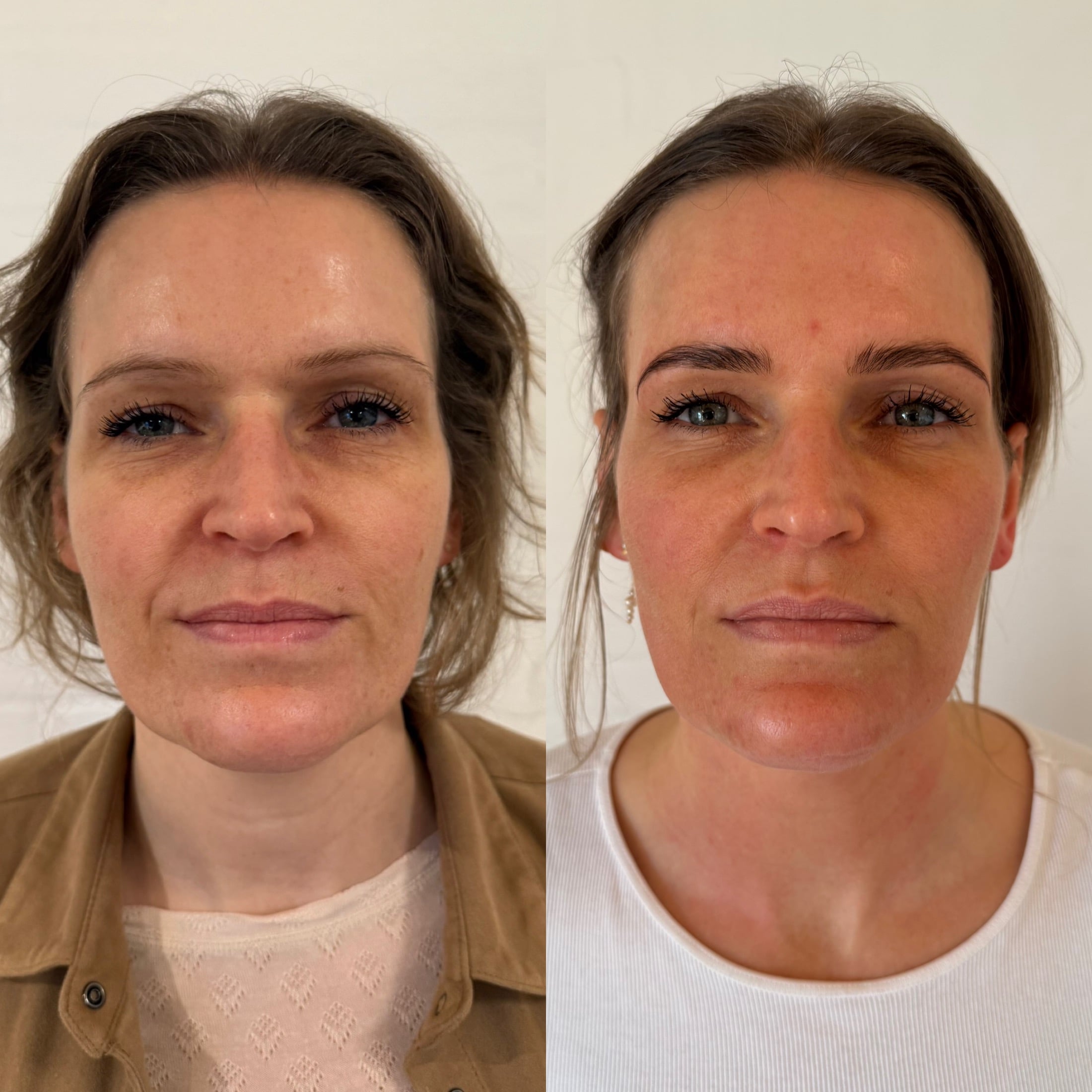 Professionel microneedling udført på klinik