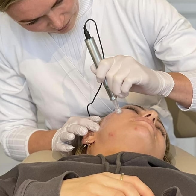 Hud med forbedret struktur efter microneedling