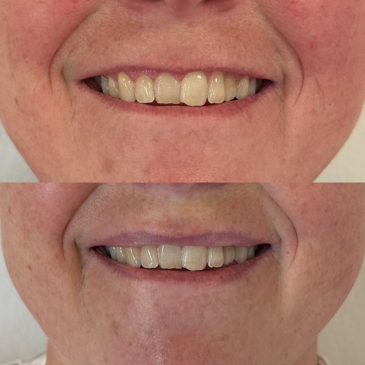 Kunde der har fået lipflip med botox hos Fyrsterling Clinic i Odense