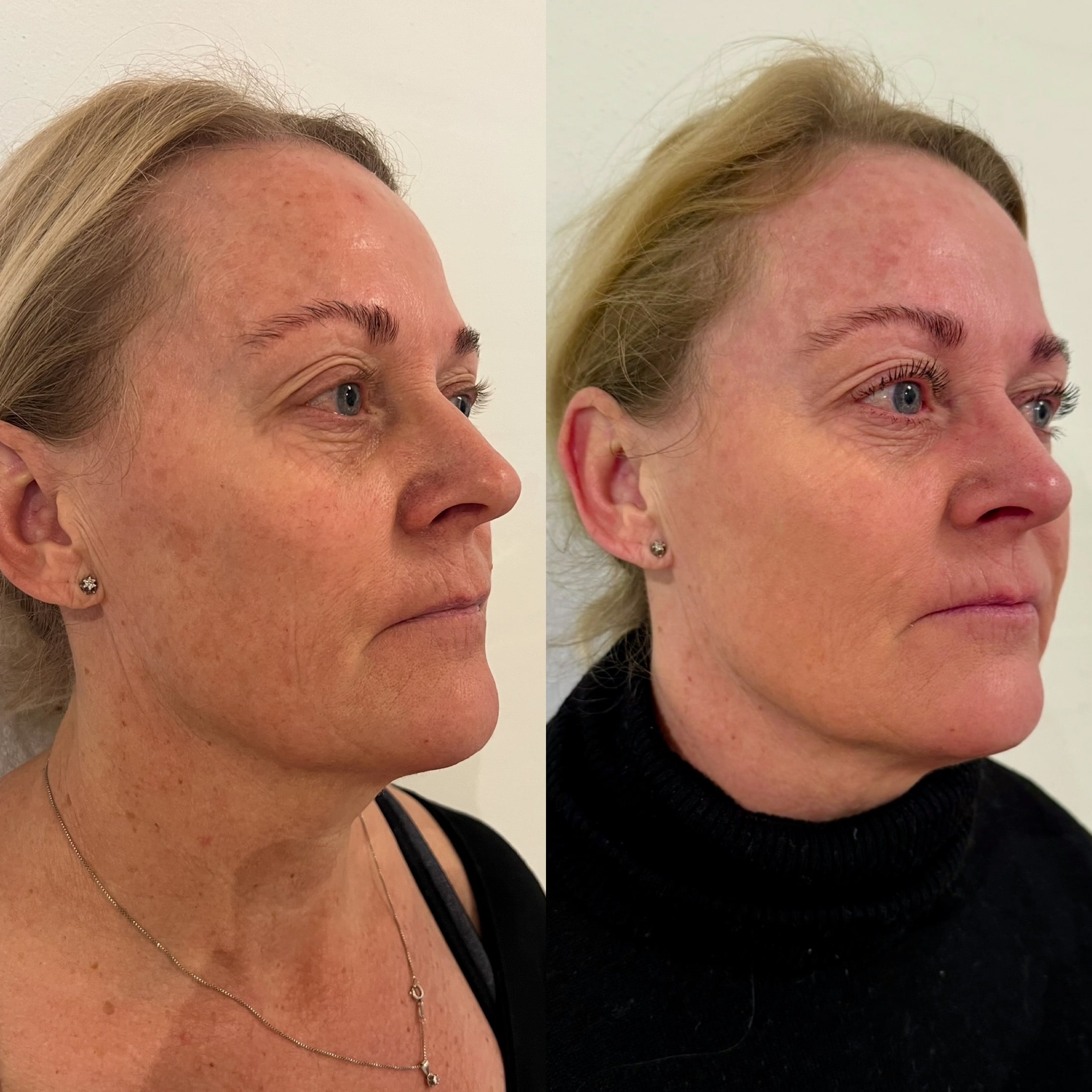 Kunde der har fået IPL for at ensarte hudtonen hos kosmetisk klinik i Odense