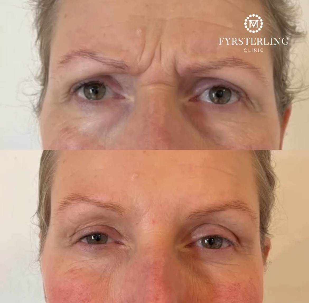 Bekymringsrynke med botox hos kosmetisk klinik i Odense tæt på Nyborg og Middelfart