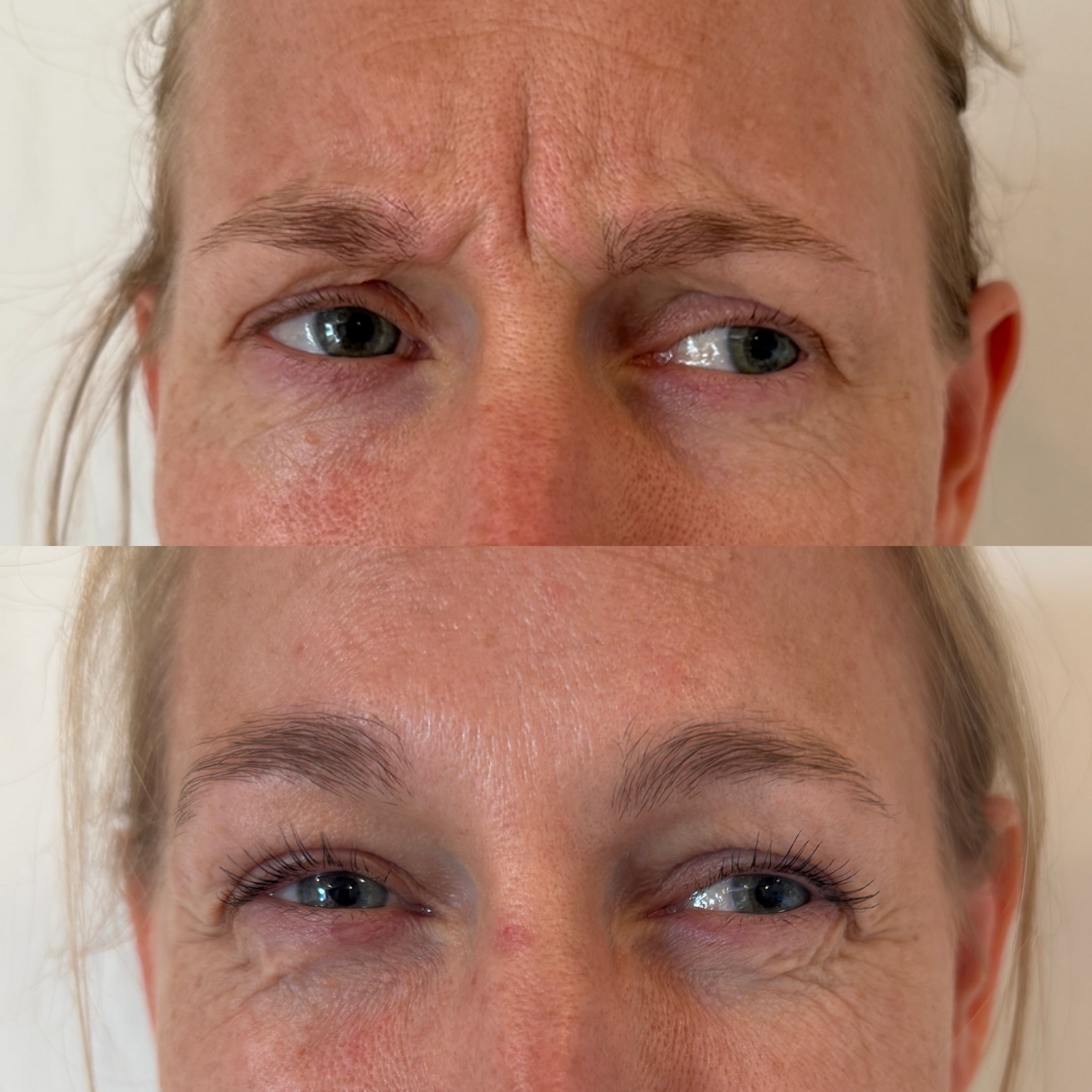 Botox i bekymringsrynken hos Fyrsterling Clinic på Fyn