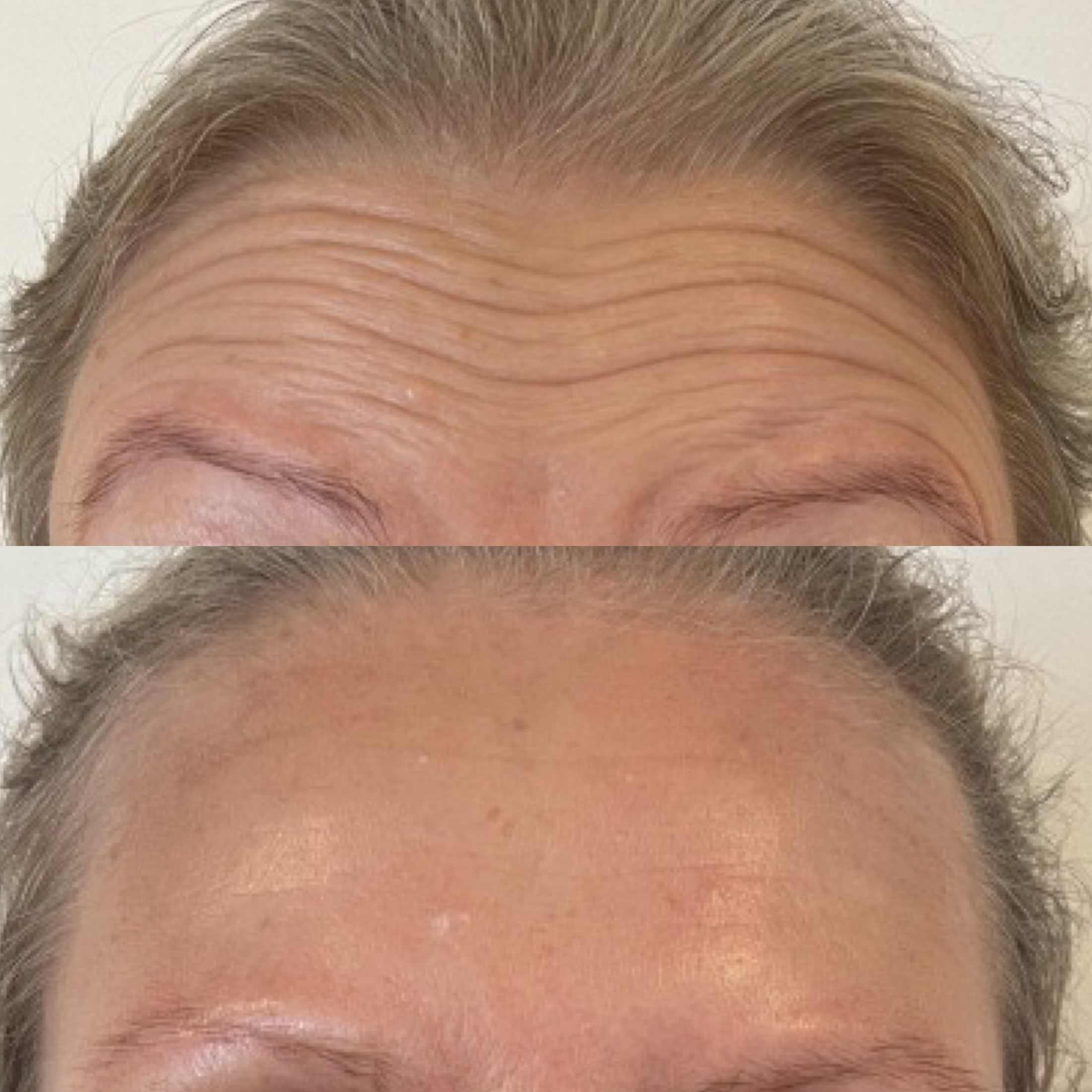 Botox i panden på kunde i kosmetisk klinik Odense 