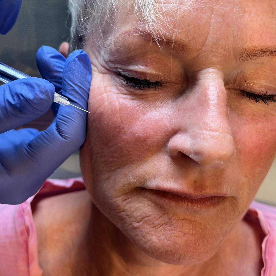 Botox mellem øjenbryn på kunde i Odense, Svendborg, Nyborg og Kerteminde