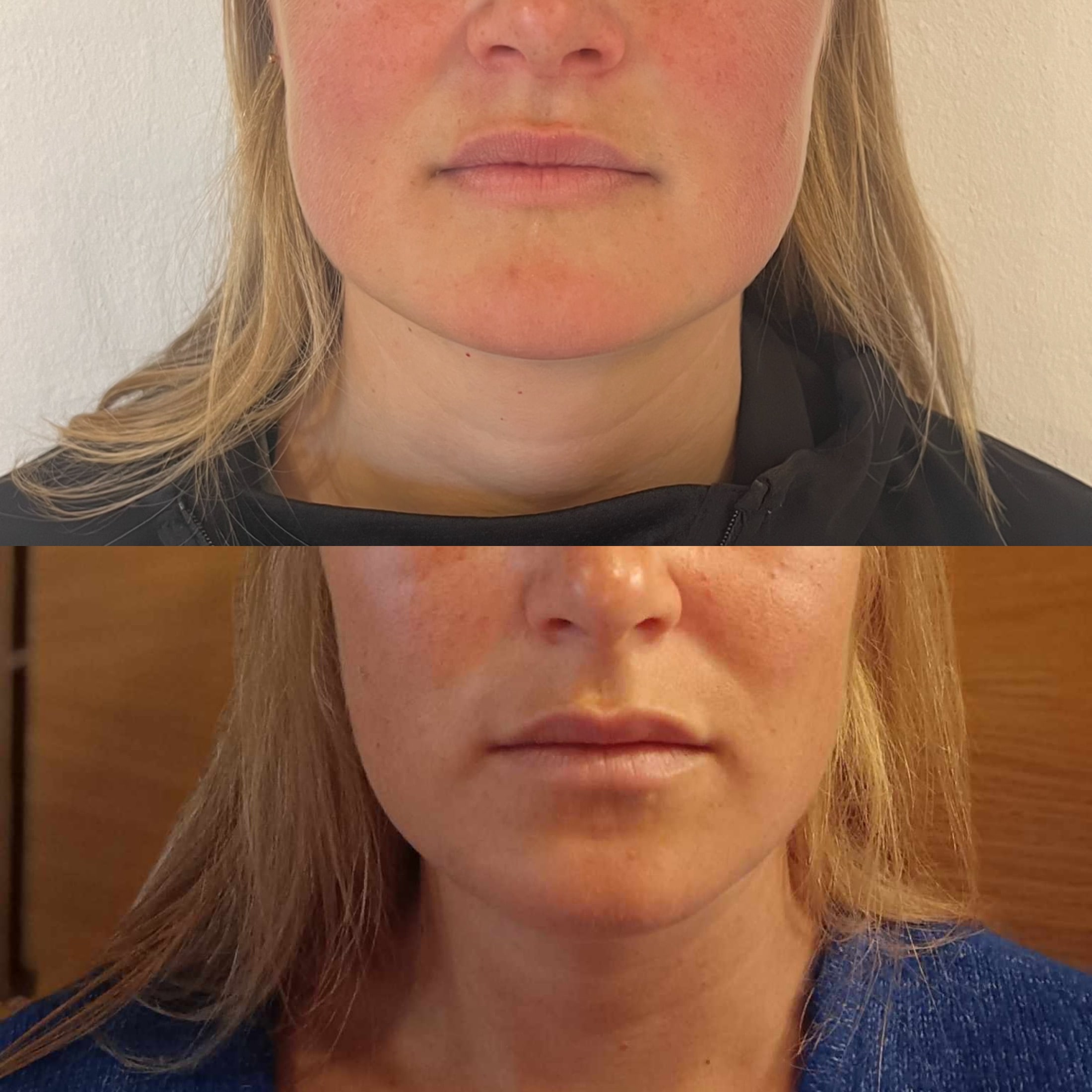 Botox masseter muskel hos Fyrsterling Clinic i Odense på Fyn
