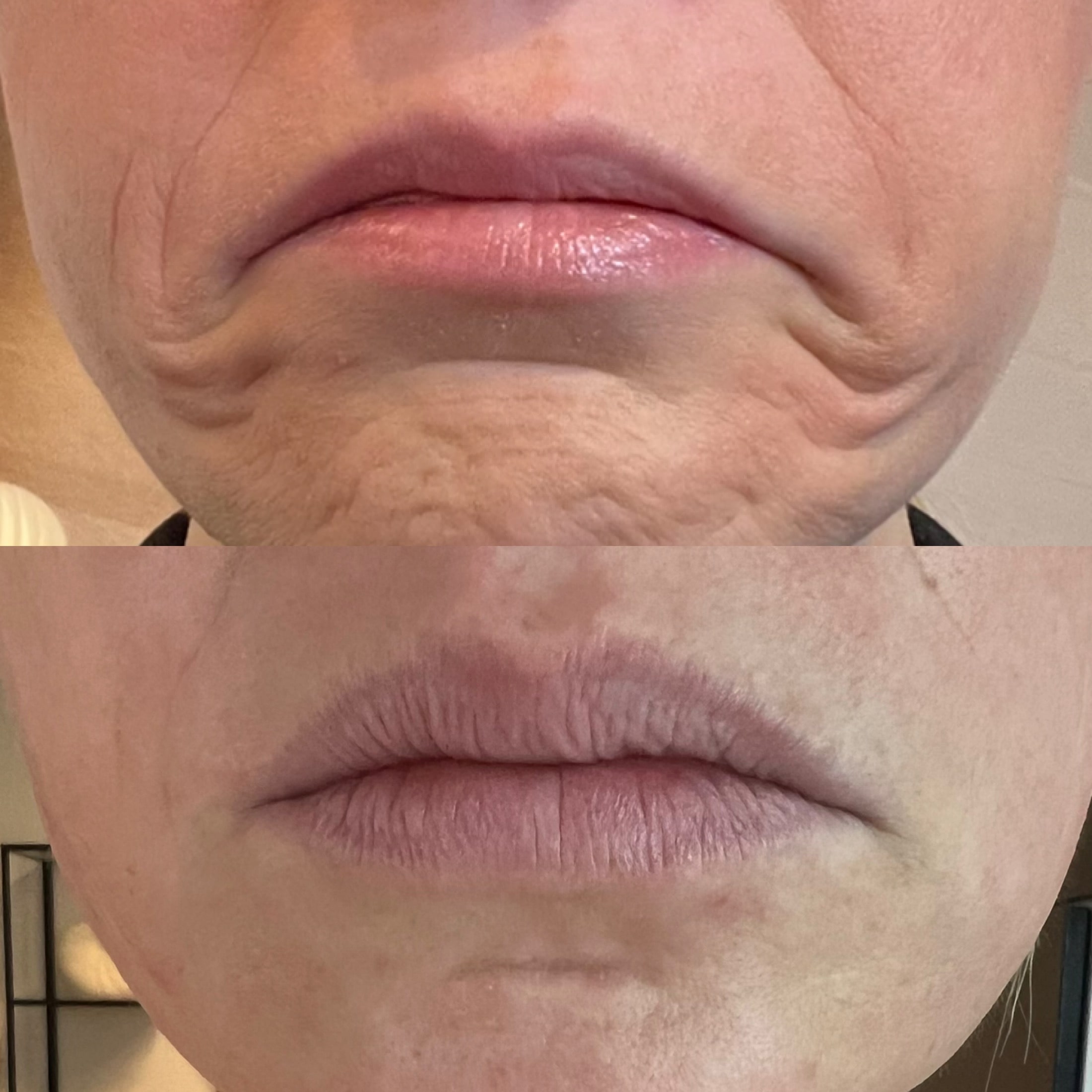 Botox nedadvendte mundvige i klinik i Odense