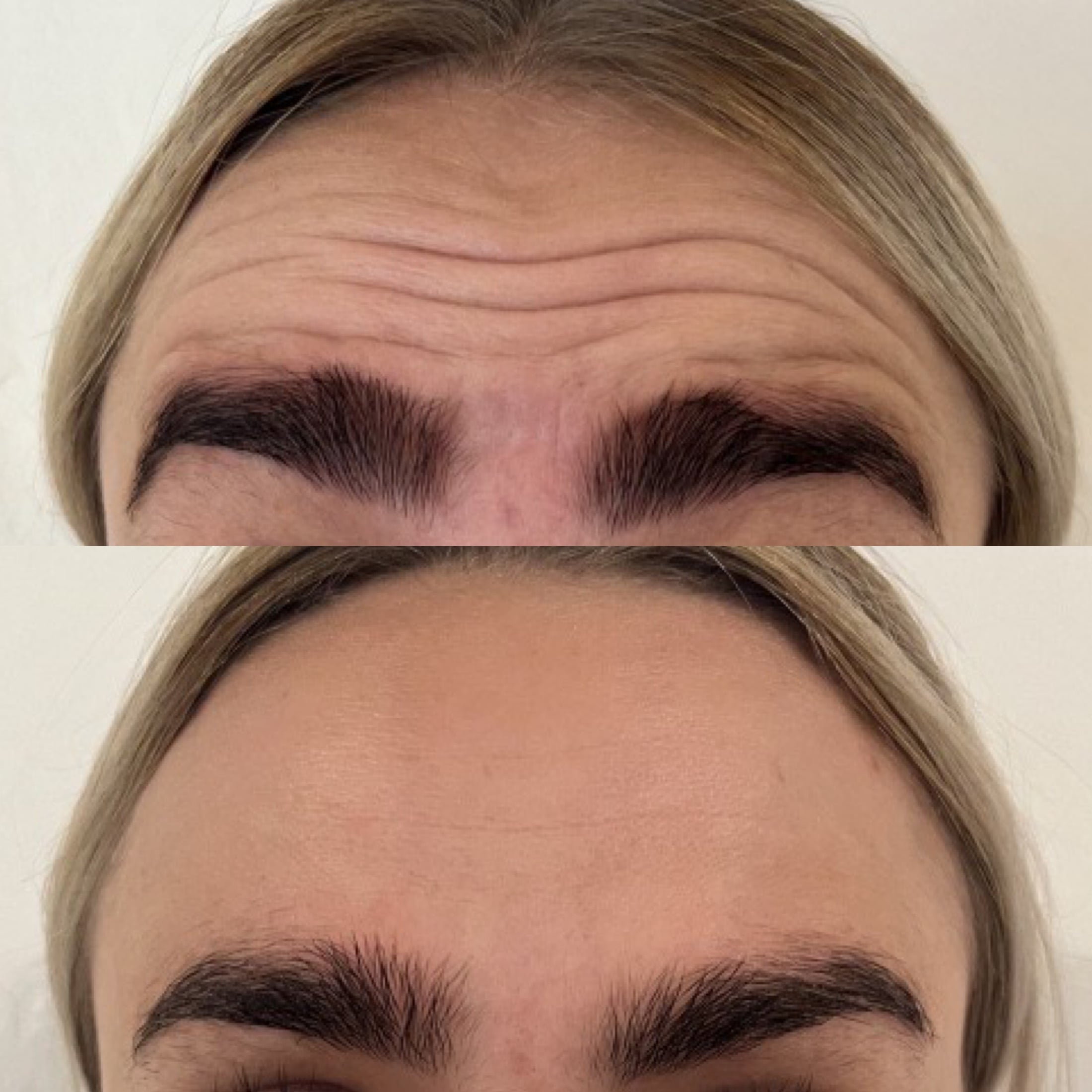 Botox mod panderynker hos kosmetisk klinik Botox Odense 