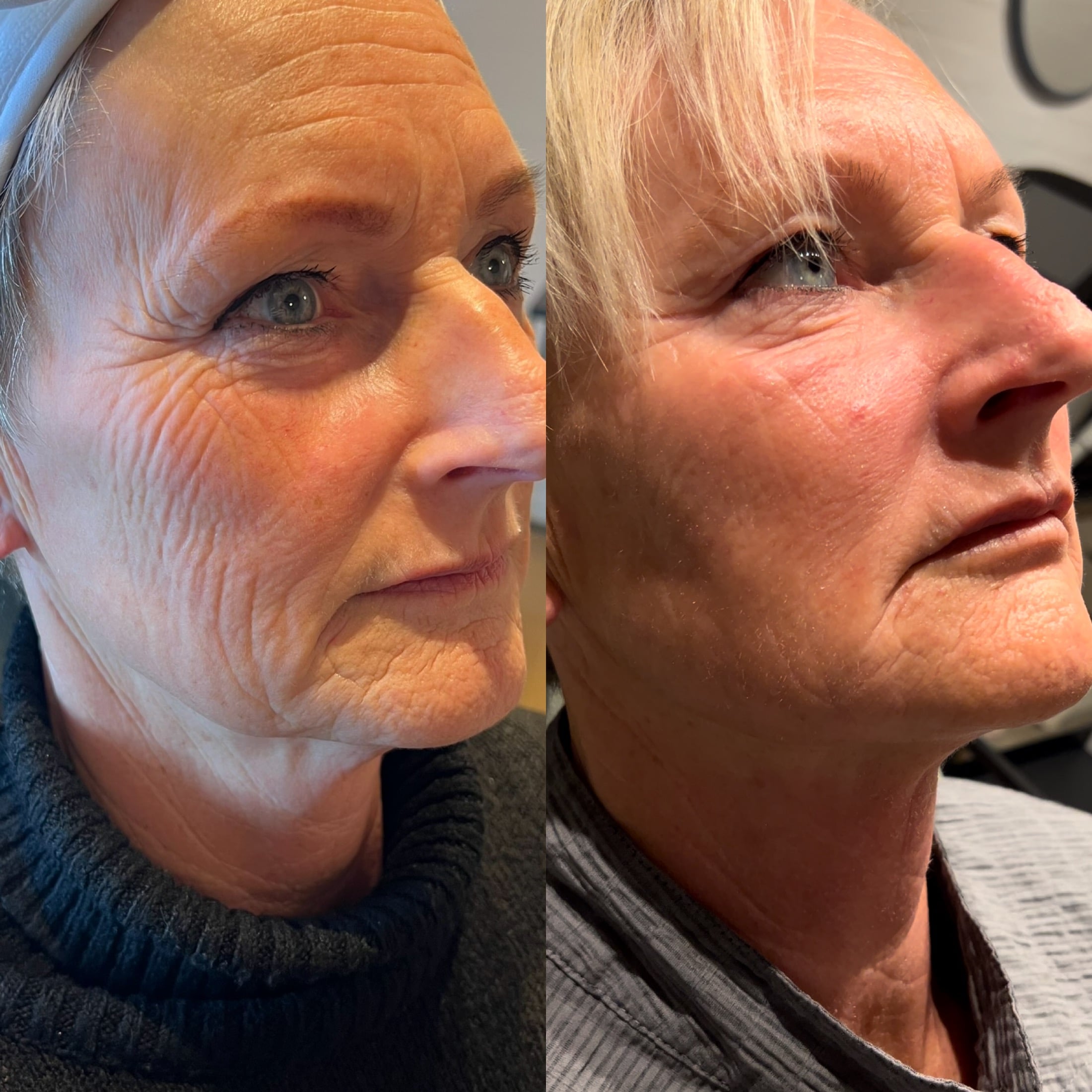 Før- og efterbillede af behandling med fillers i Odense nær Svendborg