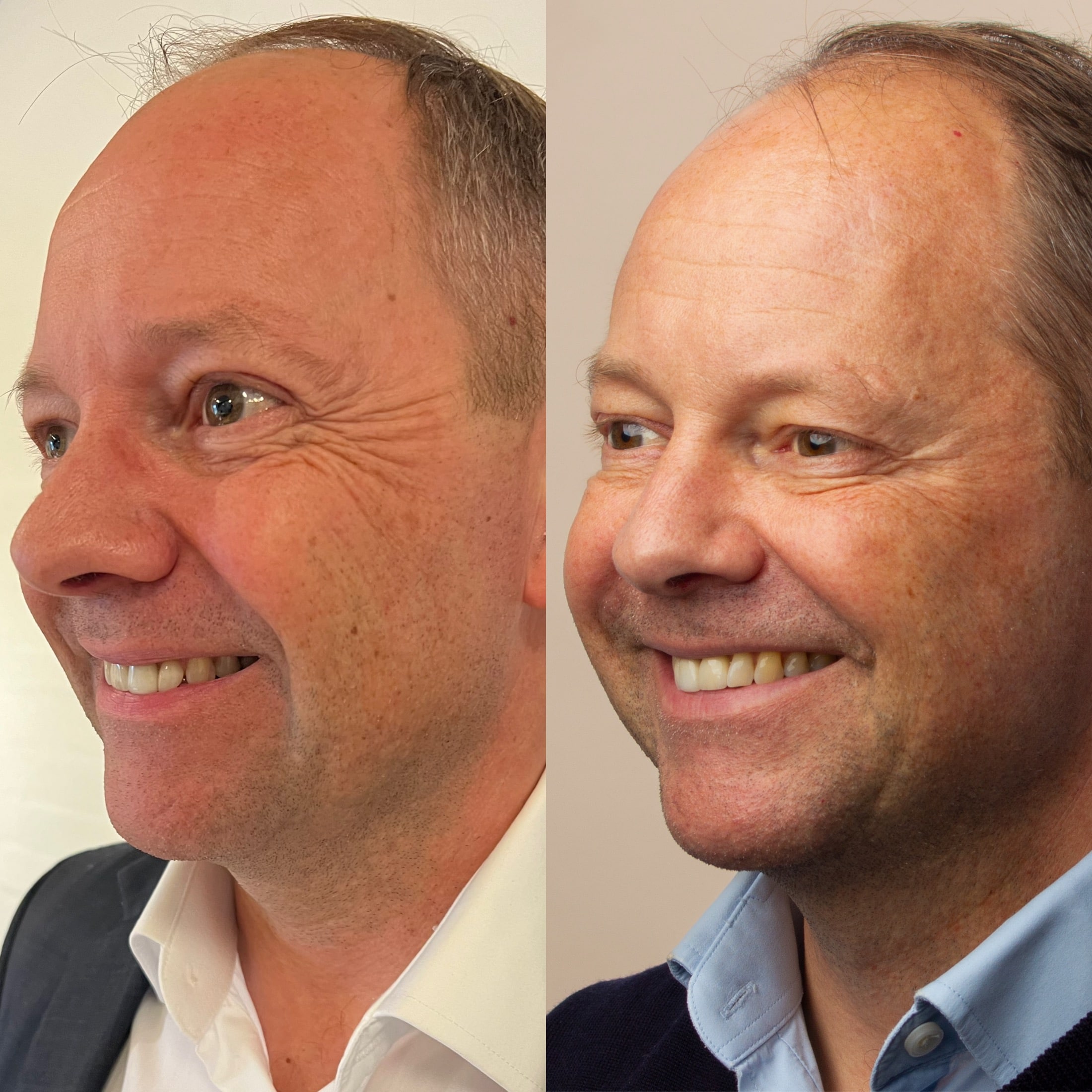 Kunde der får botox i smilerynker hos kosmetisk klinik i Odense