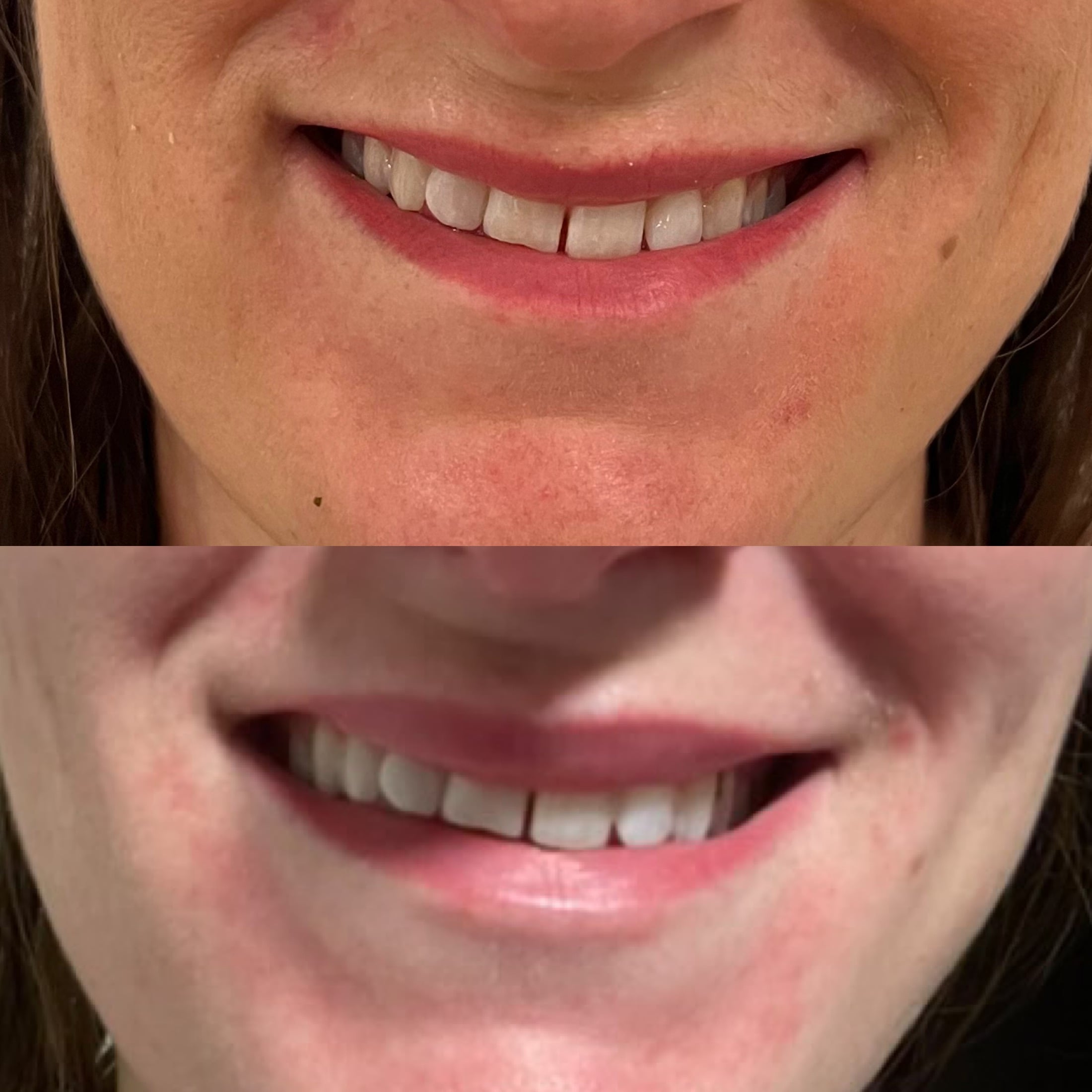 Lipflip med botox i Odense