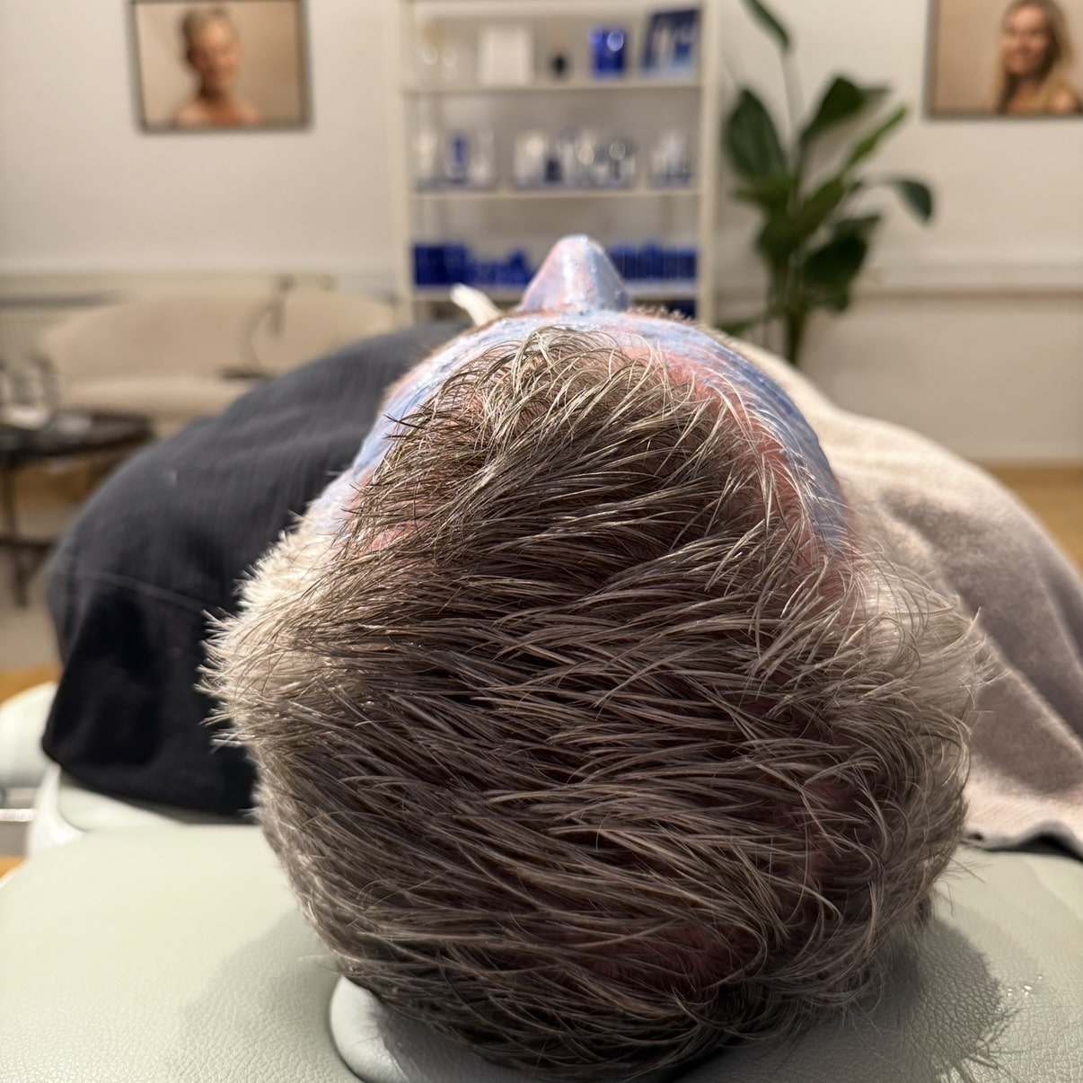 Mand der får kemisk peeling hos kosmetisk klinik i Odense på Fyn tæt på Middelfart og Assens