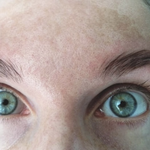 Melasma kunde hos Fyrsterling Clinic i Odense på Fyn tæt på Kolding og Vejle