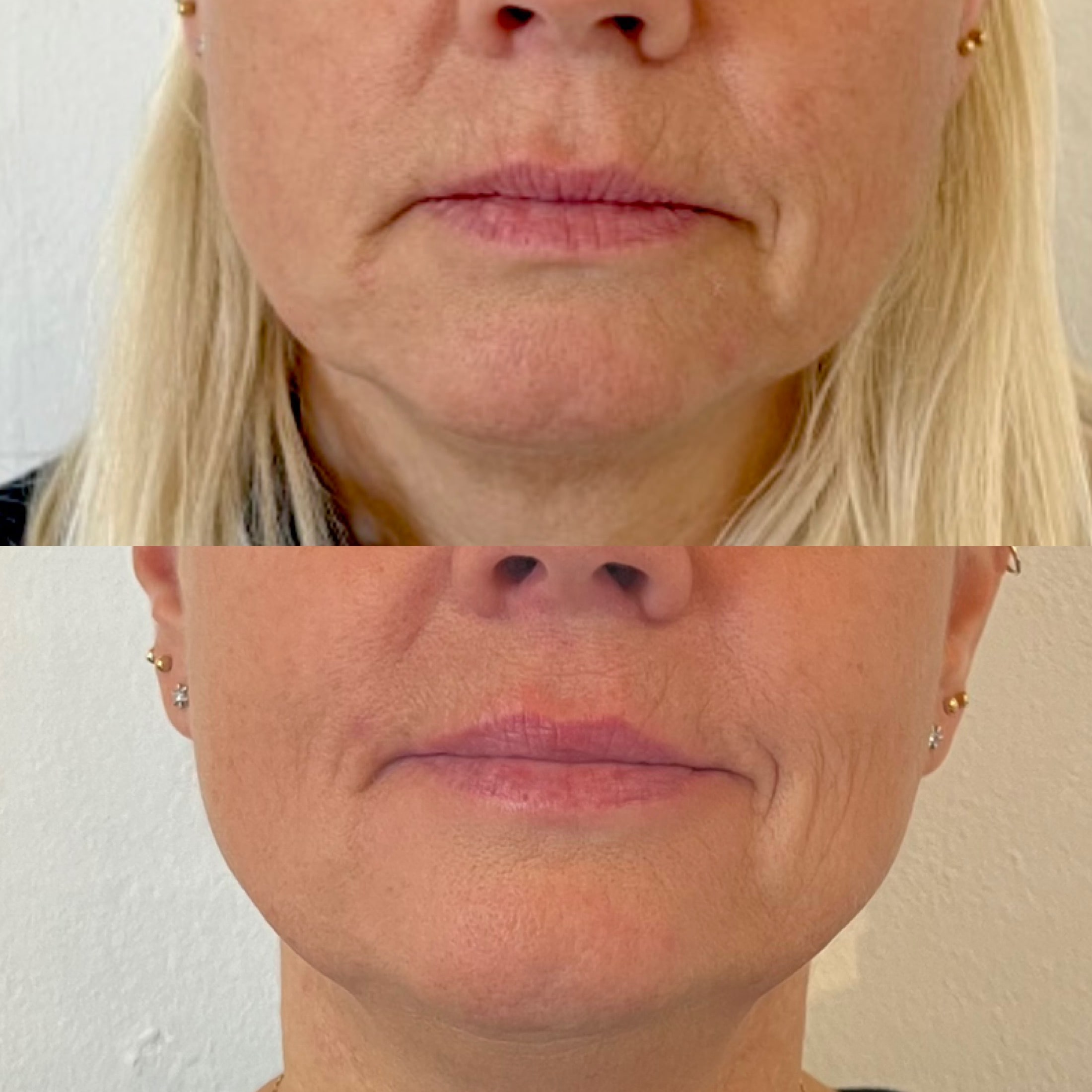 Botox i mundvige hos klinik i Odense på Fyn tæt på Kerteminde