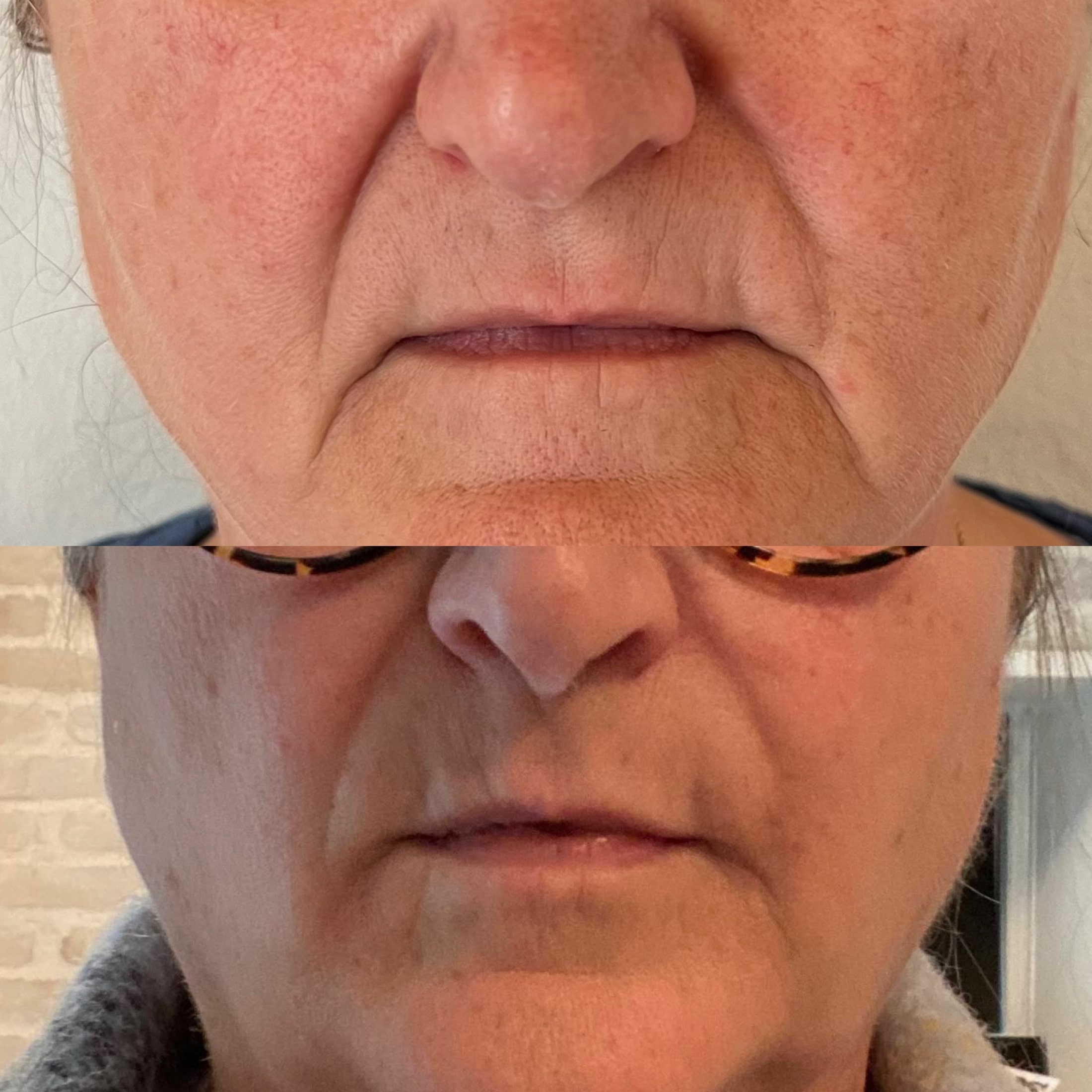 Restylane mundvige hos kosmetisk klinik i Odense på Fyn