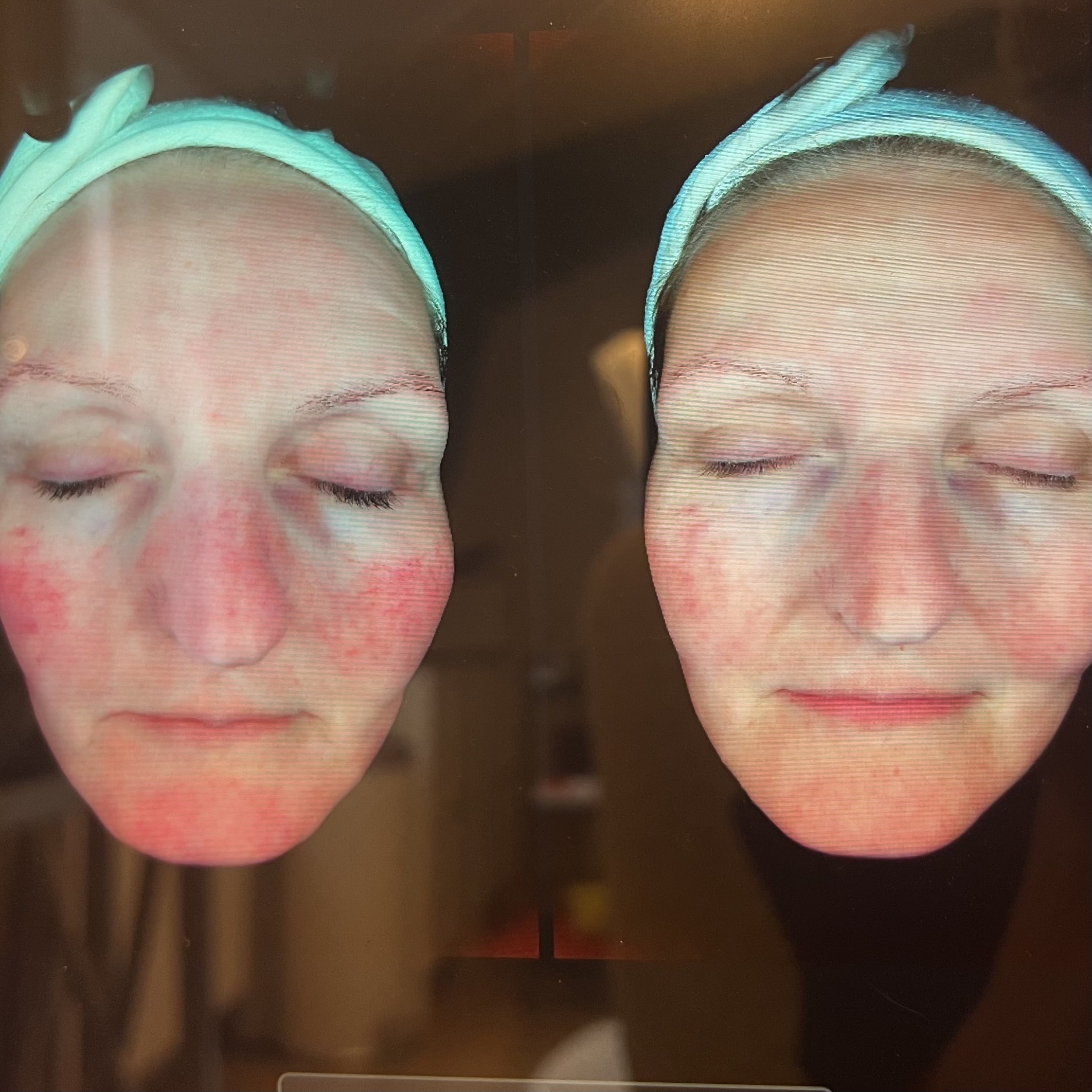 Rosacea kunde hos Fyrsterling Clinic i Odense tæt på Nyborg