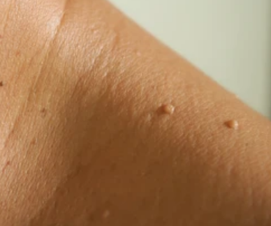 Få fjernet dine skintags hos Fyrsterling Clinic i Odense