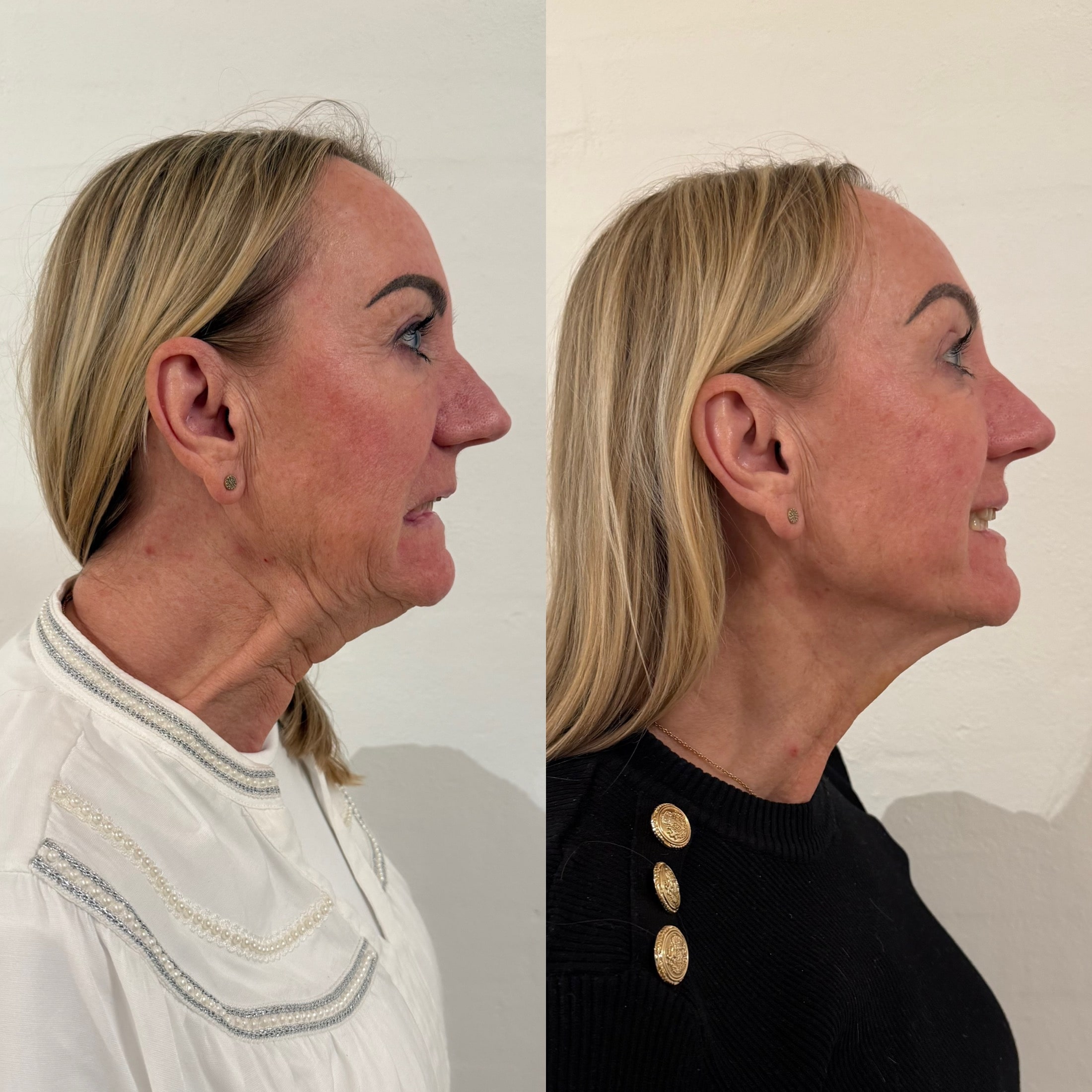 Botox til halsløft og opstrammet kæbelinje hos Fyrsterling Clinic Odense