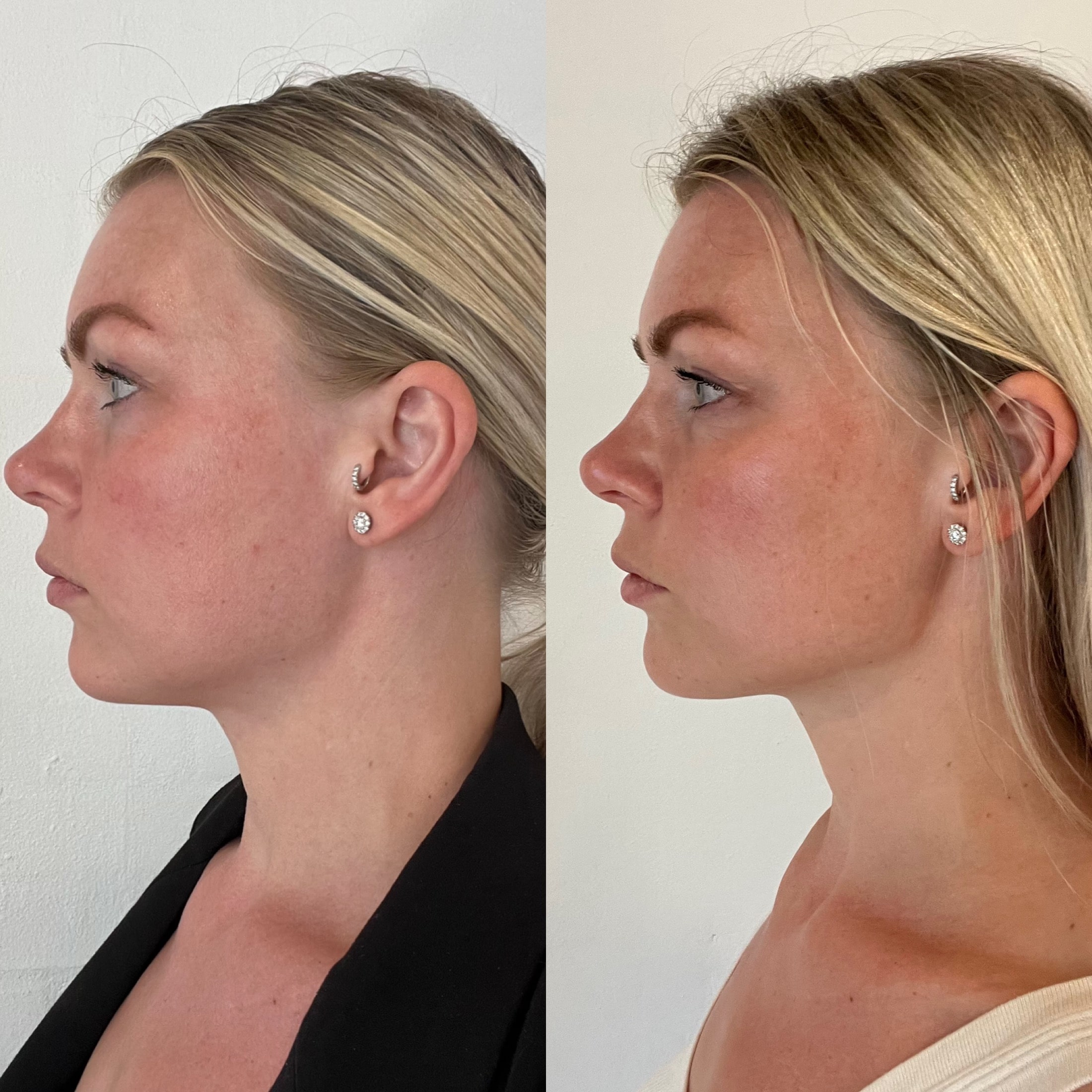 Botox langs kæbelinjen hos kosmetisk klinik Odense