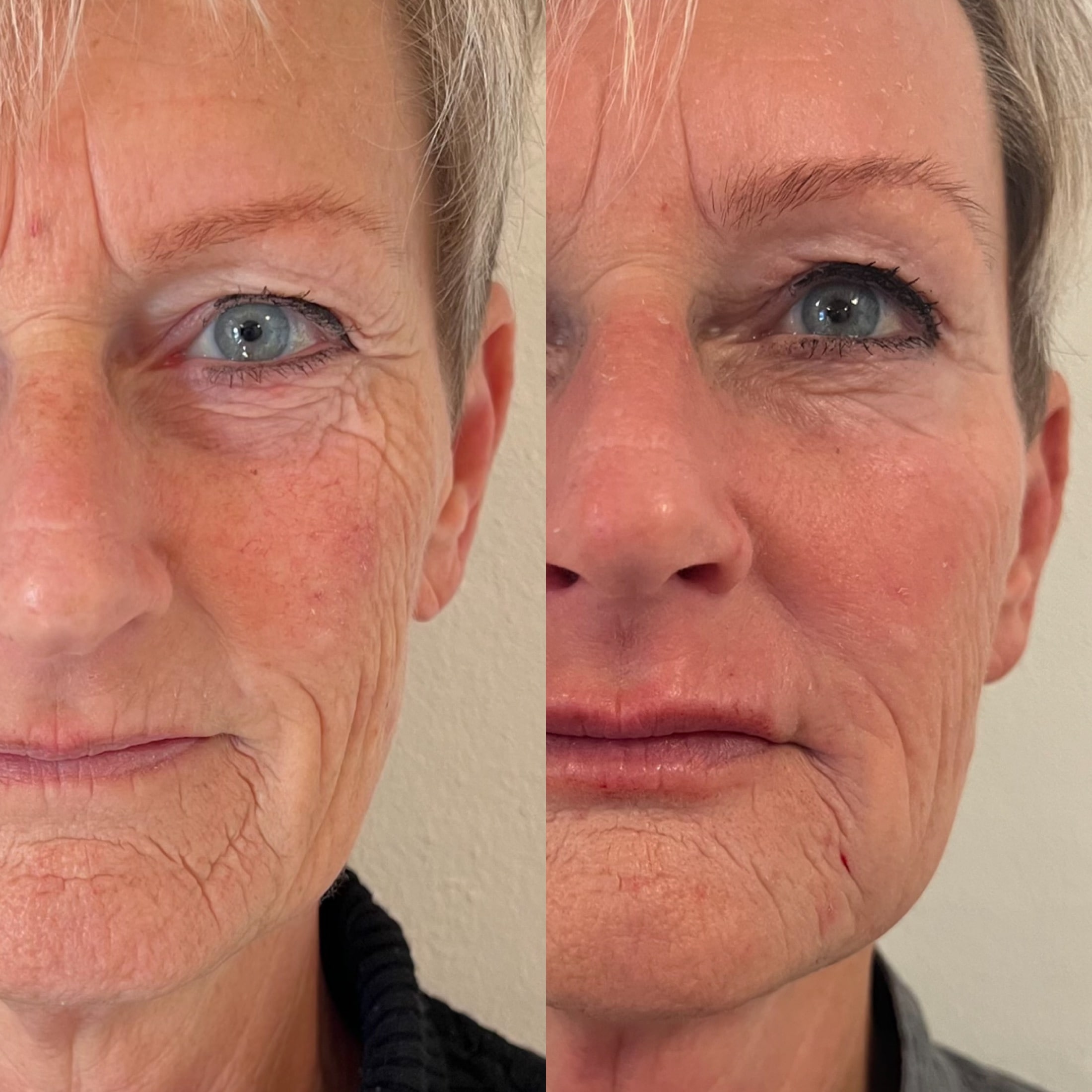 Kunde med linjer omkring munden før og efter behandling i Odense