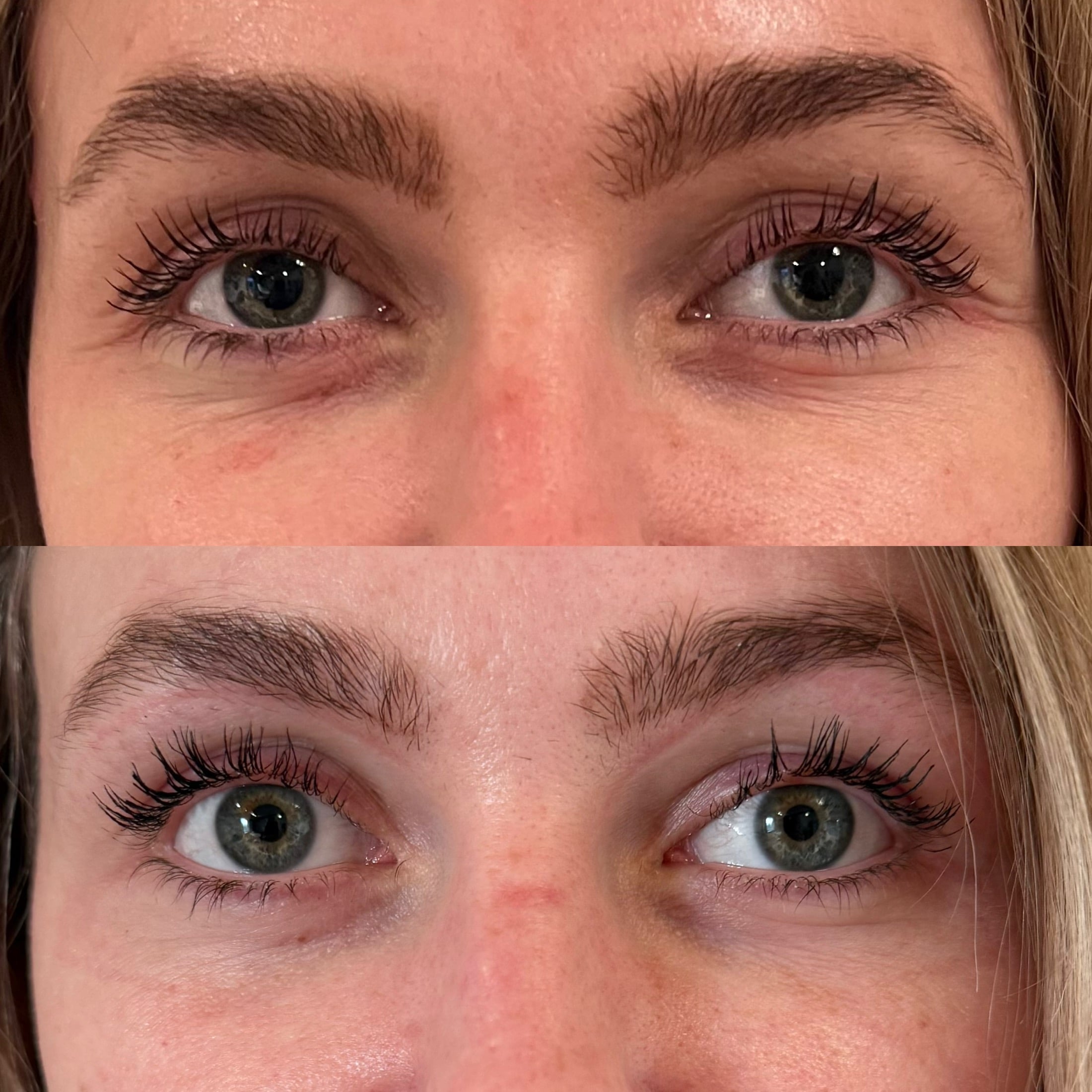 PRF-skinbooster-behandling