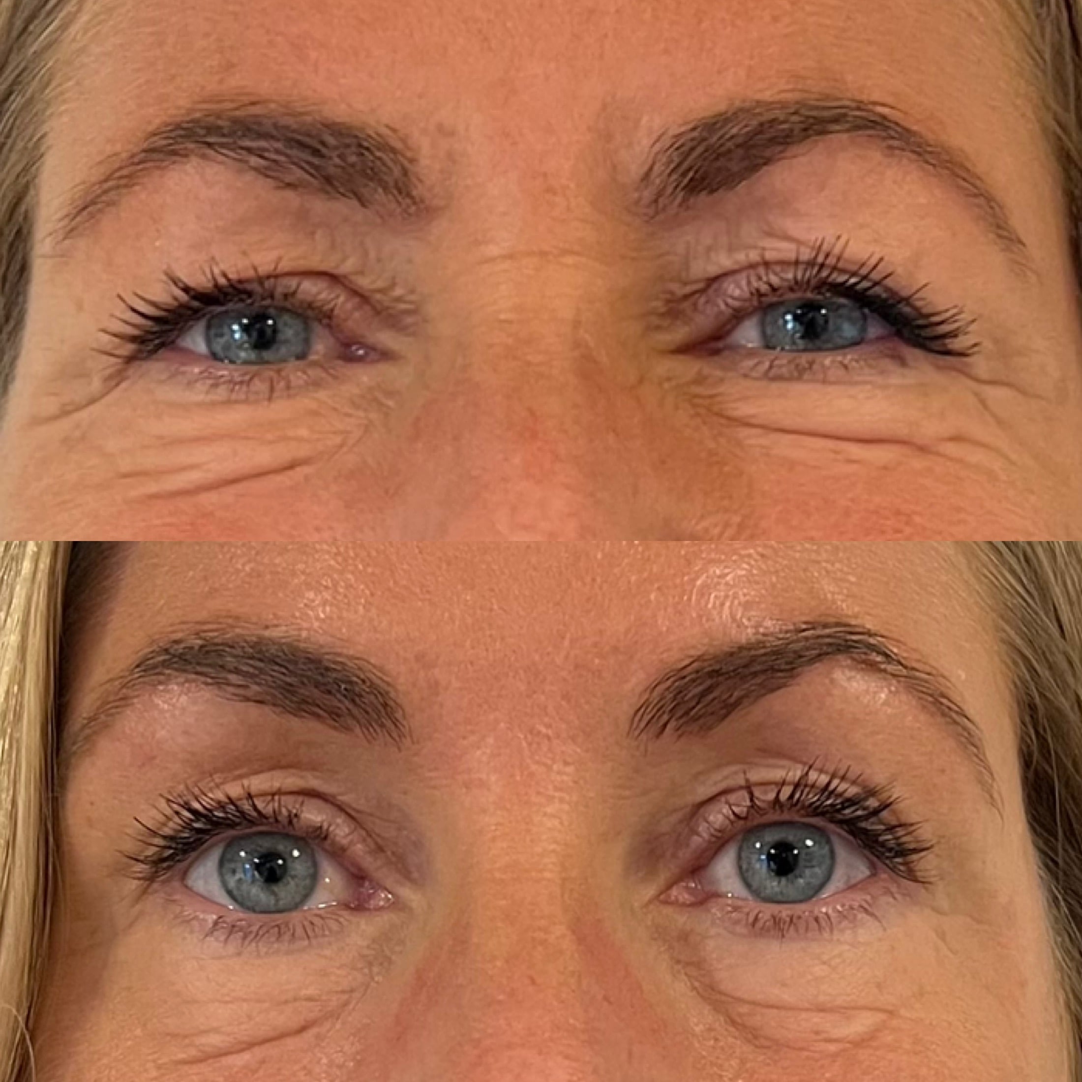 Løft af øjenbryn med botox i klinik Middelfart