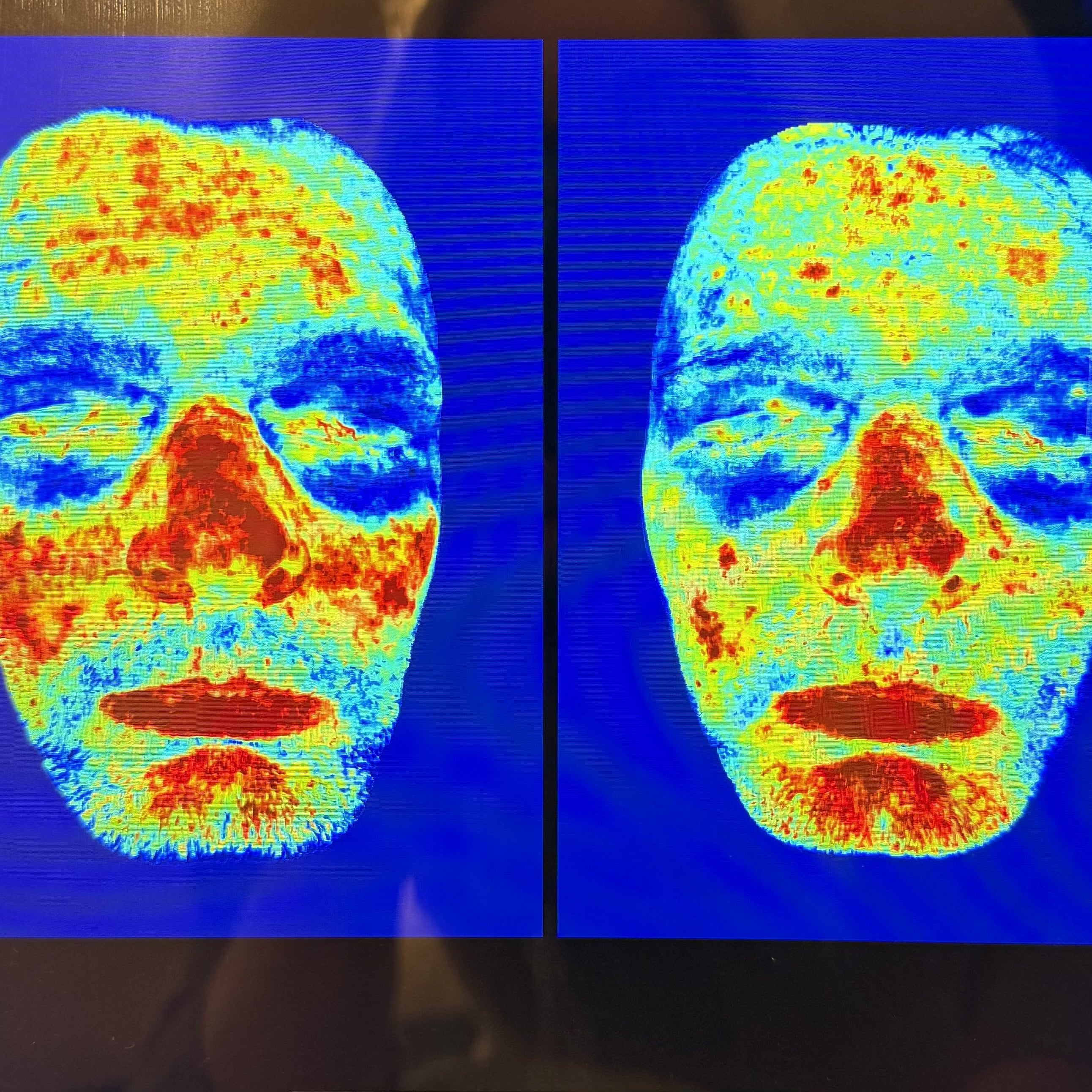 Avanceret hudanalyse hos kunde der har rosacea hos kosmetisk klinik i Odense tæt på Fredericia