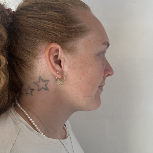 før denne kunde har fået ikke-permanent filler i hage, kæbevinkel og kæbelinje. 