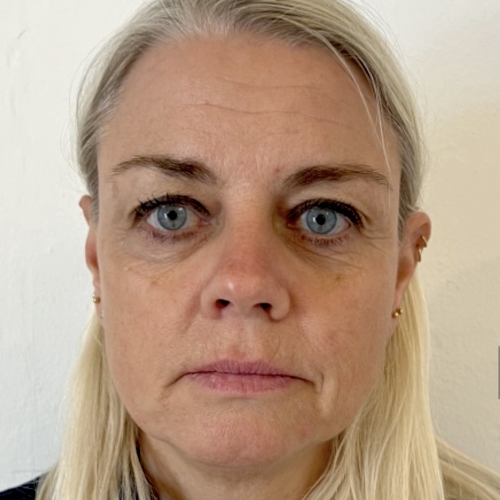 Billede af kvinde før botox i panden, bekymringsrynken, kragetæer, nedadvendte mundvige samt nefertitisløft
