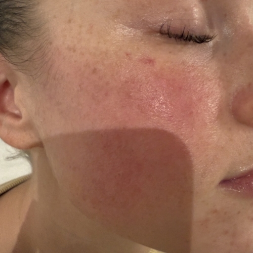 Før IPL og ZO Skin Health hudpleje