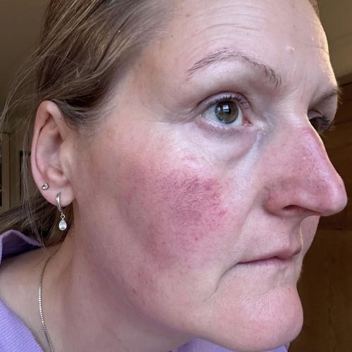 Før behandling med IPL og ZO Skin Health