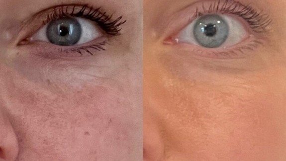 Behandling med fraktioneret CO2 laser hos Fyrsterling Clinic på Fyn