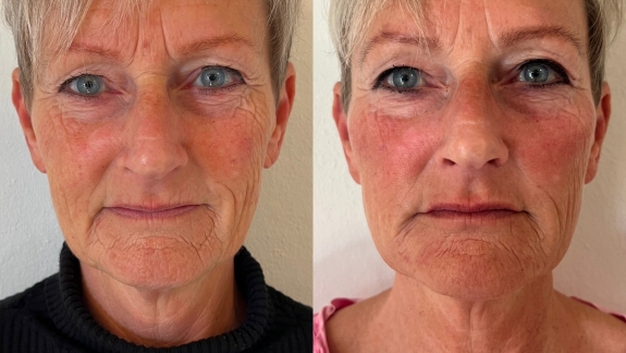 Før- og efterbillede af ikke-permanent filler - Fyrsterling Clinic i Odense