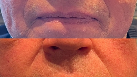 Før og efterbillede af ikke-permanent filler i læber- Fyrsterling Clinic i Odense