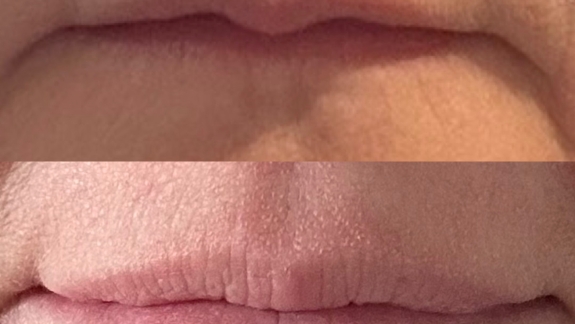 Før og efterbillede af ikke-permanent filler i læberne - Fyrsterling Clinic i Odense på Fyn