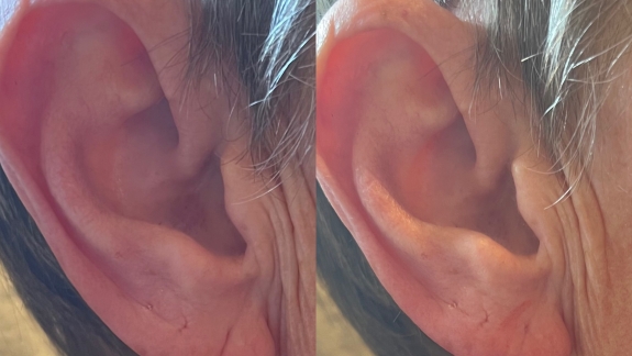 Før og efterbillede af ikke-permanent filler i øreflip - Fyrsterling Clinic i Odense