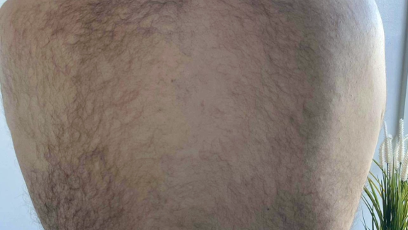 Permanent hårfjerning hos Fyrsterling Clinic i Odense