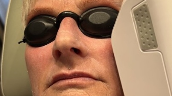 Kunde der får IPL behandling for hudforyngelse i klinik på Fyn