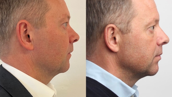 Før og efterbillede af ikke-permanent filler i kæbelinje - Fyrsterling Clinic i Odense