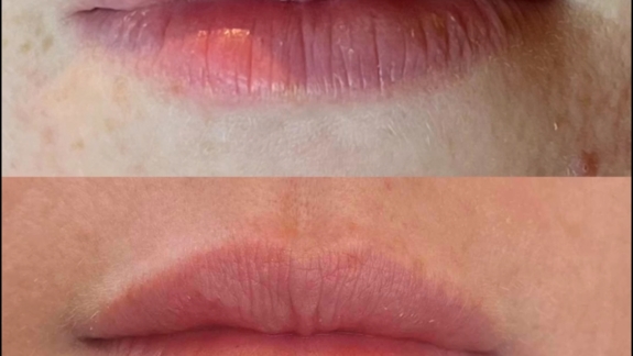 Før og efterbillede af ikke-permanent filler i læberne - Fyrsterling Clinic i Odense