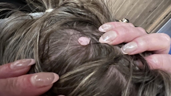 Fibrom i hovedbunden på en kunde hos Fyrsterling Clinic