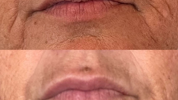 Før- og efterbillede af ikke-permanent filler i læber - Diskret forstørrelse - Fyrsterling Clinic i Odense