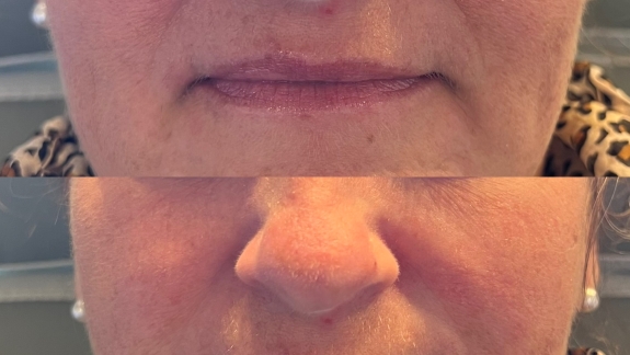 Før- og efterbillede af ikke-permanent filler i læberne - Diskret forstørrelse - Fyrsterling Clinic i Odense