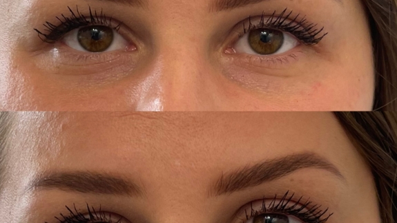 Før og efterbillede af ikke-permanent filler i tear through - Fyrsterling Clinic i Odense