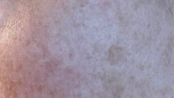 ZO Skin Health Antiaging hudpleje fra Fyrsterling Clinic