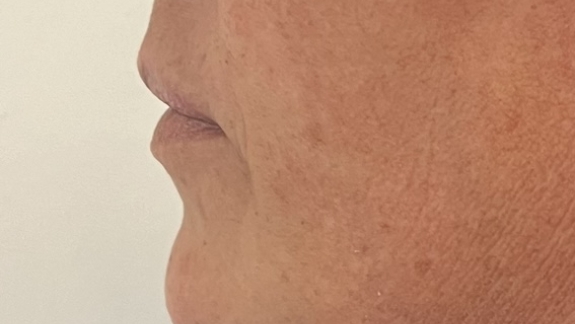 Efter ikke-permanent filler i hagen hos Fyrsterling Clinic på Fyn