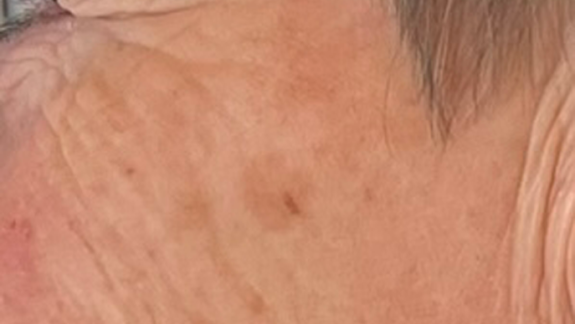 Kunde der bruger ZO Skin Health lavet af Fyrsterling Clinic på Fyn