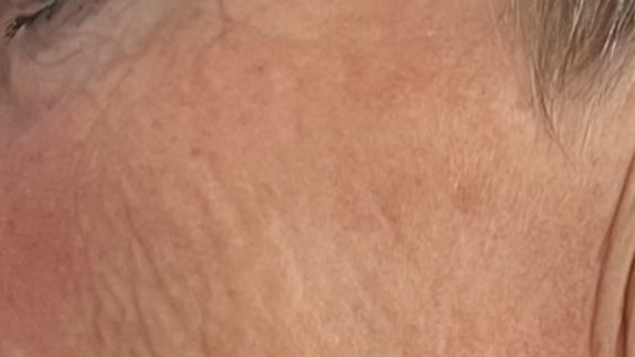 Kunde der bruger ZO Skin Health lavet af Fyrsterling Clinic på Fyn