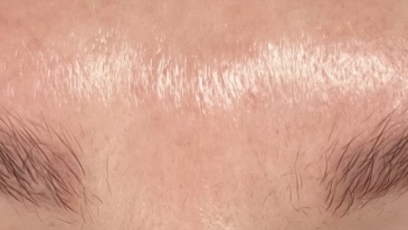 Efter-billede microneedling hos Fyrsterling Clinic