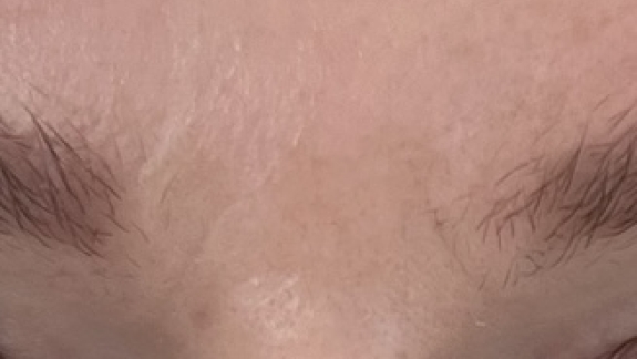 Før-billede microneedling hos Fyrsterling Clinic